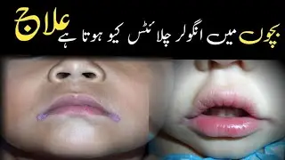 Angular stomatitis causes and treatment in children/monh k Kono me infection ka ilaj