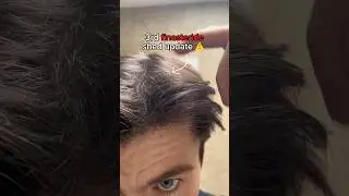 3rd finasteride shed update! - The regrowth ‼️
