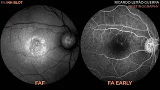 Ink-blot pattern (CSCR fluorescein angiography)
