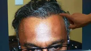 Restoring 20 Years of Youth | 1-Year Hair Transplant with Natural Zigzag Hairline &ndash; Dr. John Diep