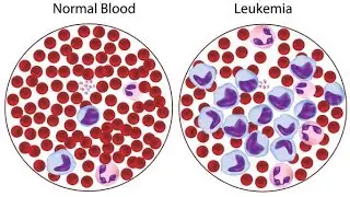 Lymphocytic Leukemia #cure with #ayurveda @DrJAYANTBATRA #diet 