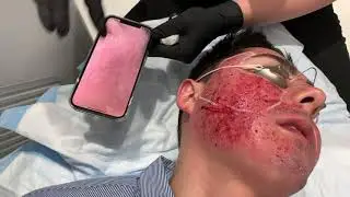 IMPROVE CHEEK ACNE SCARS WITH DEEP HALO AND PROFRACTIONAL LASER |West Hollywood, CA | Dr. Jason Emer