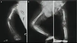 X-rays of Syphilitic sabre tibia; classic radiographic finding seen in congenital syphilis