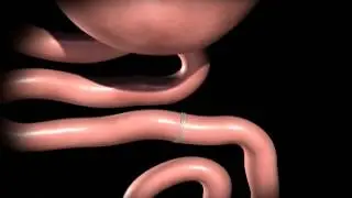 Roux-en-Y Gastric Bypass - Marc Zare, Bariatric Surgeon Jacksonville