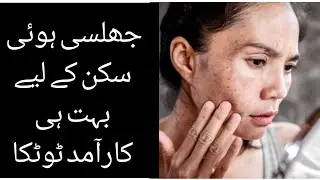 how to remove burn marks permanently || jali hui skin k daghon k lye tip | جلی ہوئی سکن کے لیے ٹوٹکا