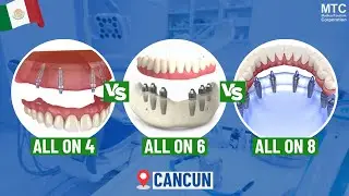 All on 6, All on 8 vs All on 4 Dental Implants - Cancun Surgeon