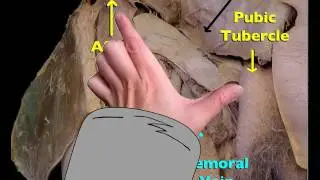 V Technique: Finding the Femoral Vein