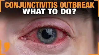 Conjunctivitis Outbreak | Delhi's Rising Eye Infections | How To Prevent Infection | News9