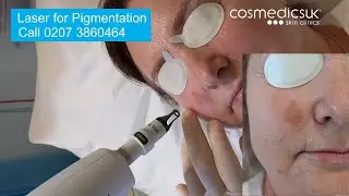 Laser for facial pigmentation & sun damage treatment demo - see before and after results