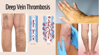 Deep Vein Thrombosis - Symptoms , Causes and Treatment with Tiens