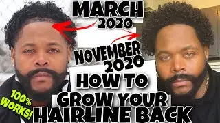 How I GREW MY HAIRLINE Back Super FAST!! 100% WORKS!!