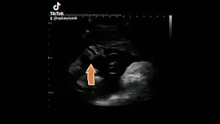 How to get 3D & 4D Ultrasound Face Pictures! Explained!