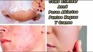 Mascarilla Natural Para Cerrar Los Poros. Eliminar Puntos Negros. Acn&eacute; Y Marcas