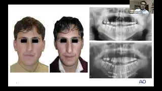 AO CMF online seminar&mdash;Orthognathic Surgery
