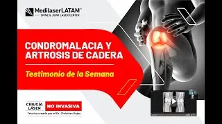 Condromalacia y Artrosis de Cadera | TESTIMONIO | Medilaser LATAM