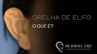 Orelha de Stahl, conhecida como orelha de elfo: diagnóstico e correção com a otoplastia.