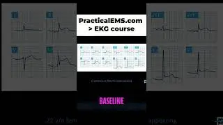 Diffuse ST Elevation & PR Depression: MI Pattern?