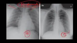 PA vs AP view | Chest radiology |