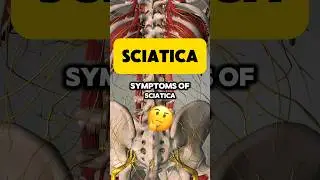 You probably don’t have SCIATICA 🤷‍♂️