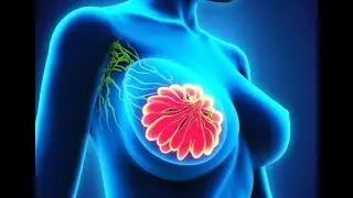 African Ancestry and Triple Negative Breast Cancer