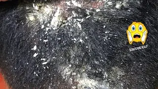 itchy scratching ||  dandruff removal off big flakes  || ASMR Scratching #78