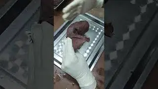 demo on liver