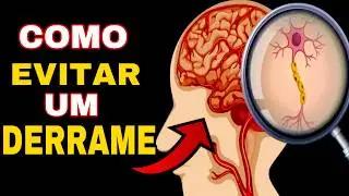 FA&Ccedil;A ISSO para EVITAR o DERRAME | 9 Dicas para PREVENIR o AVC (Acidente Vascular Cerebral)