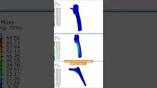 #femur bone and it's implant stress countors in total hip replacement surgery simulation in #Abaqus