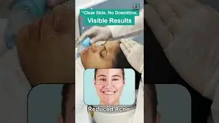 Carbon Laser Peel Explained! Instant Glow, Zero Downtime | Skin Treatment