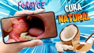 Como ELIMINAR los Granos de FORDYCE de Forma NATURAL