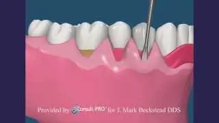 Soft Tissue Grafting - Mid-Peninsula Periodontics