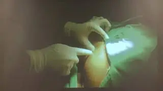 HOW I DO IT? - ABDOMINAL WALL BLOCKS BY LOR TECHNIQUE BY DR HETALKUMAR VADERA
