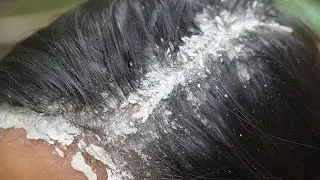ASMR Scalp Check: Crunchy Flakes, Itchy Spots & Instant Relief #408