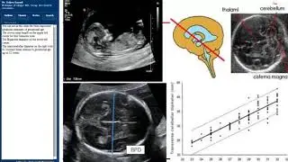 Post term pregnancy