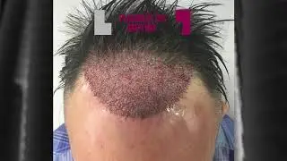 GREFFE DE CHEVEUX FUE | NYC | Dr Nathan YADUN | ROUEN