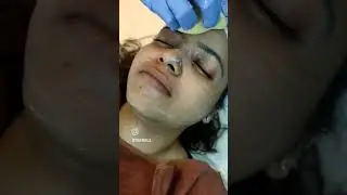 Advance yellow peel💛#youhealwithanaesthetictouch #cosmetology #skincare #skinhealth #pigmentation