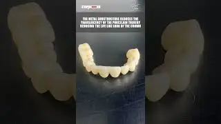 Metal Ceramic PFM vs All Ceramic Zirconia Crowns - Which is Better for Front Teeth ? #dentalcrowns