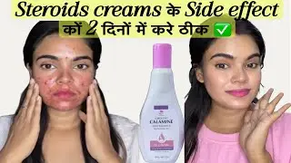 Steroid Cream Side Effects Cure | Thin Skin, Redness & Pimples Treatment | 