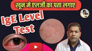 IgE Test | IgE Test Kya Hota Hai | IgE Level |#allergytest #HighIgE