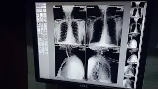 Barium swallow // Xray procedure// Special study #xray  #barium #filming #radiography #swallow 