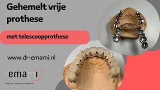 Gehemelte vrije prothese, telescoop-prothese, kunstgebit zonder gehemelte