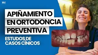CASOS CLÍNICOS DE APIÑAMIENTO EN ORTODONCIA PREVENTIVA