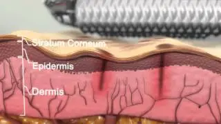 Clear + Brilliant Laser Treatment