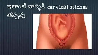 cervical striches in pregnancy#pregnencycare# గర్భం లో గర్భాశయ ముఖద్వారానికి కుట్లు ఎందుకు వేస్తారు?