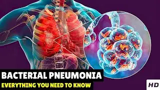 Bacterial Pneumonia &ndash; Causes, Signs and Symptoms, Diagnosis & Treatment