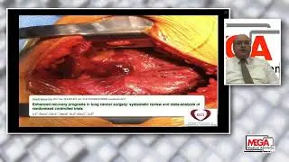 ERACS: Enhanced Recovery After Cardiac Surgery. Mohamed R El Tahan, MD