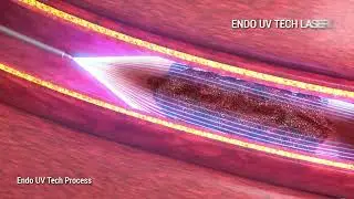Endo UV Tech's Patented UV Laser Technology to Eliminate Stroke Side Effects Before They Happen