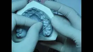 adams clasp wire bending