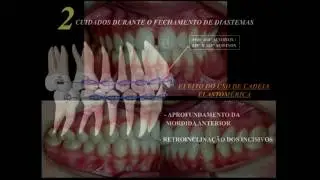 Fechamento de diastemas - cadeia elastomérica - Prof. Dr. Pedro Andrade Jr