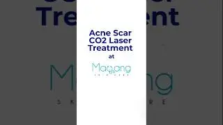 Acne Scar CO₂ Laser Treatment Explained |  by Dr. Anil Soni | Mayang Skin Care